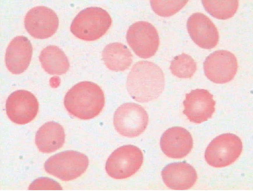 红细胞大小不均